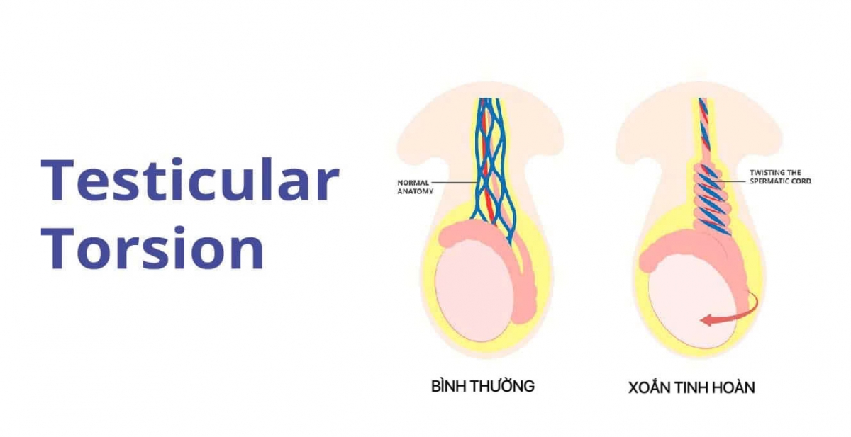 Cứu hai ca xoắn cơ quan sinh dục hiếm gặp, đe dọa khả năng sinh sản
